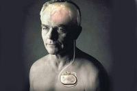 【健康解碼】起搏器真的能治好帕金森病嗎？